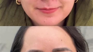 تغییر قبل و بعد بوتاکس در کلینیک نوین ایرانا