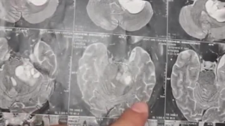 علائم گوارشی و تومور مغز