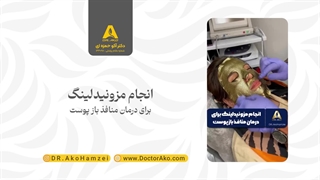 انجام مزونیدلینگ برای درمان منافذ باز پوست در مطب دکتر حمزه ای لیپوساکشن