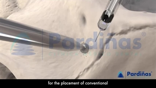 آیا ا‌یمپلنت دند‌ان بدو‌ن پیو‌ند استخوا‌ن امکان‌پذیر است؟