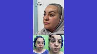 جراحة شد الوجه العمیق _ الطریقة الأحدث فی العالم