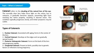 کاتاراکت (آب مروارید): علل، علائم، پیشگیری و روش‌های درمان