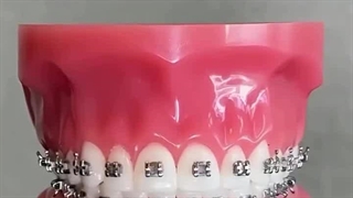 بلیچینگ دندان تبریز در جناب مگ