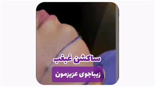 ساکشن غبغب در مشهد