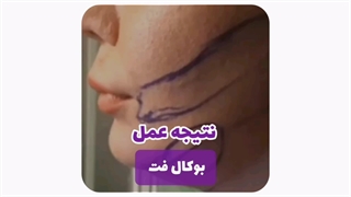 بوکال فت در مشهد