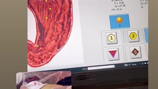 نتایج درمانی خانم قلی پور با دستگاه بیوفیلیا