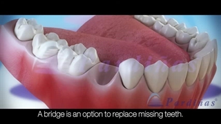 پروتز دندان ثابت