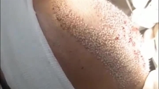 کلینیک کاشت مو