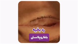 دکتر بلفاروپلاستی در مشهد
