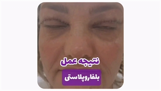 دکتر جراحی پلک در مشهد