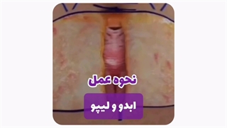 عمل ابدومینوپلاستی در مشهد