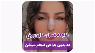 عمل بدون جراحی بینی