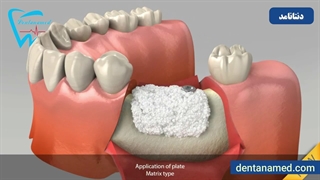 آموزش استفاده از ممبران دندانپزشکی
