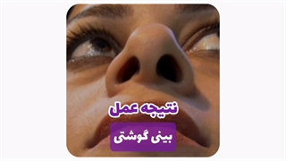 عمل بینی گوشتی در مشهد