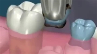 کشیدن زود به هنگام دندان شیری