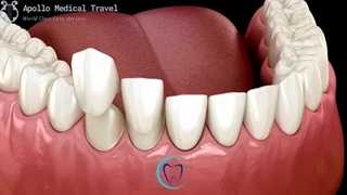 لمینت دندان چگونه است؟