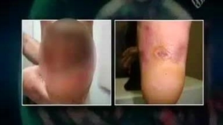 درمان پای دیابتی با زالو درمانی و طب سنتی اسلامی |صنعت زالو ایران