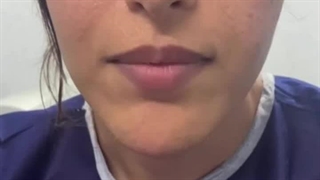 جراحی زنانه سازی صدا