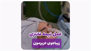 هزینه عمل بینی نیمه فانتزی در مشهد
