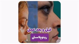 عکس قبل و بعد عمل بینی در مشهد