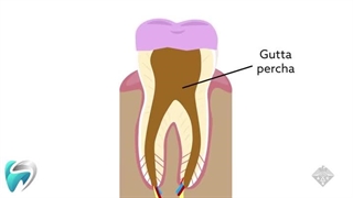 نحوه عصب کشی دندان