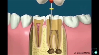 نحوه عصب کشی دندان
