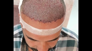 کاشت موی تخصصی در شیراز