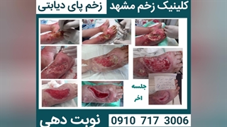 کلینیک زخم مشهد ● درمان زخم پای دیابتی ● دکتر زخم مشهد ● 09107173006 ● محمد متولی حقیقی لیپوساکشن