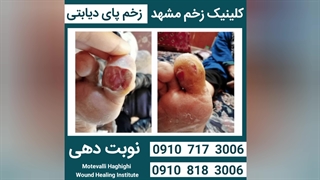 کلینیک زخم مشهد ● درمان زخم پای دیابتی ● دکتر زخم مشهد ● 09107173006 ● محمد متولی حقیقی زاویه سازی صورت