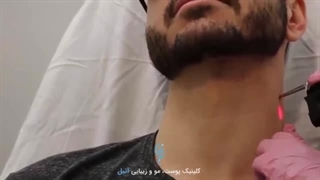 لیزر موهای زائد آقایان درمان ریزش مو