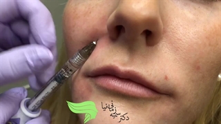 تزریق فیلر خط خنده ابرسانی پوست