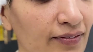 دکتر حمید وحیدی رفع افتادگی پلک