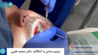 ترمیم و پر کردن دندان با آمالگام در شیراز - دکتر محمد طیبی