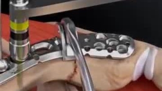 ترمیم شکستگی دیستال ترقوه – روش‌ها و مراحل جراحی