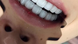 دکتر امیر خداداد کاشت ریش