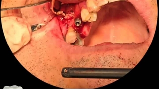 ایمپلنت رایگان آقای عباسی در دندانپزشکی دکتر حمید پورصادقی در میدان پاستور تهران