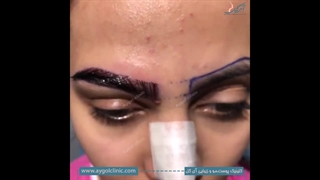 فرم‌دهی و طراحی و کاشت ابرو متناسب با چهره شما – نتایج واقعی!