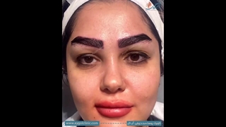 کاشت ابرو طبیعی و زیبا در کلینیک زیبایی آی گل – راهی نو برای زیبایی شما!