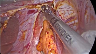 درمان جراحی آشالازی مرحله آخری با میوتومی هلر لاپاراسکوپی