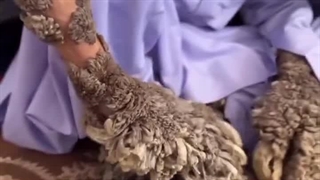 بیماری مرد درختی؛ عبدالنصیر نتوژهیشاد شهروند 35 ساله بلوچ