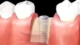 شماتیک مراحل کار ایمپلنت دندان تکی