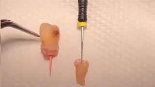 کشیدن ریشه دندان شکسته