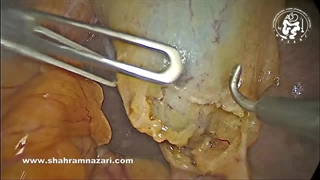 تنوع در عروق کیسه صفرا: شریان‌های دوتایی کیسه صفرا