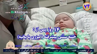 ختنه نوزاد پسر