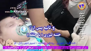 ختنه نوزادان پسر