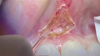 لیزر در دندانپزشکی