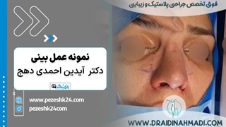 نمونه کار دکتر آیدین احمدی جراح بینی در همدان - پزشک 24