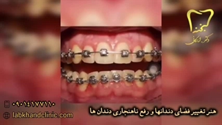 درمان کجی و فاصله بین دندان‌ها