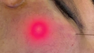 چرا لیزر اندولیفت؟  کلینیک مانا رکورددار لیزر اندولیفت در سال 1403