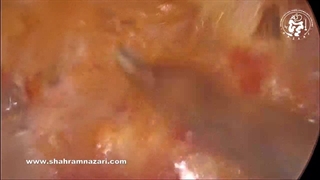 ترمیم فتق نافی با مش